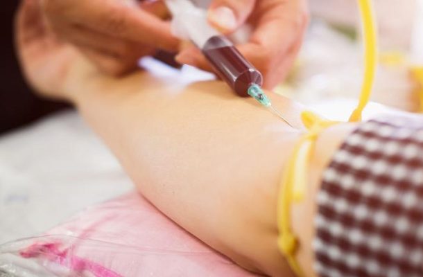 برای نخستین بار در دنیا؛ یک زن مبتلا به اچ‌آی‌وی با پیوند سلول‌های خون بند ناف درمان شد