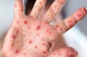 ابتلای ۹۶ نفر به سرخک در کشور / وزارت بهداشت: تزریق واکسن ضروری است