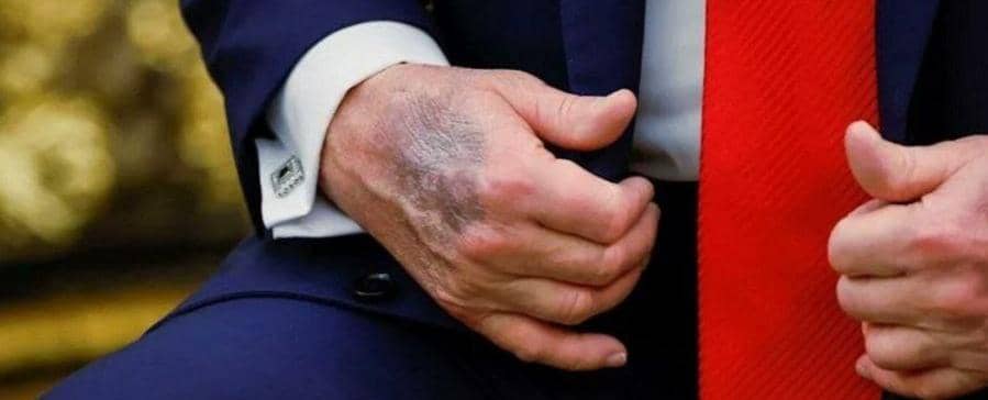 دست‌ های ترامپ دوباره خبرساز شدند